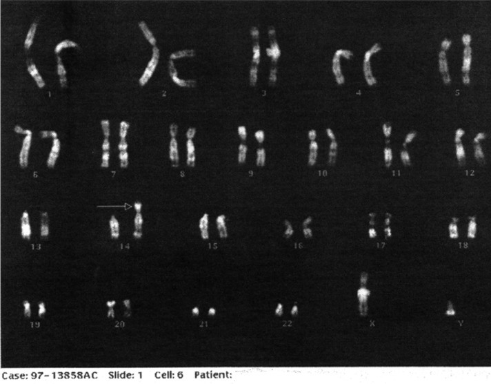 trisomie par translocation 14-21 trisomie par translocation 14-21